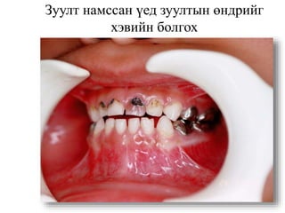 Зуулт намссан үед зуултын өндрийг
хэвийн болгох
 
