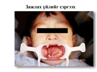 Зажлах үйлийг сэргээх
 