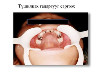 Түшилцэх гадаргууг сэргээх
 
