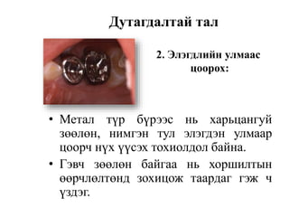• Метал түр бүрээс нь харьцангуй
зөөлөн, нимгэн тул элэгдэн улмаар
цоорч нүх үүсэх тохиолдол байна.
• Гэвч зөөлөн байгаа нь хоршилтын
өөрчлөлтөнд зохицож таардаг гэж ч
үздэг.
Дутагдалтай тал
2. Элэгдлийн улмаас
цоорох:
 