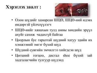 Хэрэглэх заалт :
• Олон шүдийг хамарсан ШЦӨ, ШЦӨ-ний идэвх
өндөртэй үйлчлүүлэгч
• ШЦӨ-нийг хянахын тулд амны хөндийн эрүүл
ахуйг сахиж чадахгүй байгаа
• Цоорлын бус гаралтай шүдний хатуу эдийн их
хэмжээний эмгэг бүхий шүд
• Шүдний сувгийн эмчилгээ хийгдсэн шүд
• Цөгцний гогцоо, дистал shoe бүхий зай
хадгалагчийн тулгуур шүдэнд
 