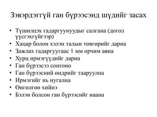 Зэвэрдэггүй ган бүрээсэнд шүдийг засах
• Түшилцэх гадаргуунуудыг салгана (догол
үүсгэхгүйгээр)
• Хацар болон хэлэн талын төвгөрийг дарна
• Зажлах гадаргуугаас 1 мм орчим авна
• Хурц ирмэгүүдийг дарна
• Ган бүрээсээ сонгоно
• Ган бүрээсний өндрийг тааруулна
• Ирмэгийг нь нугална
• Өнгөлгөө хийнэ
• Бэлэн болсон ган бүрээсийг наана
 