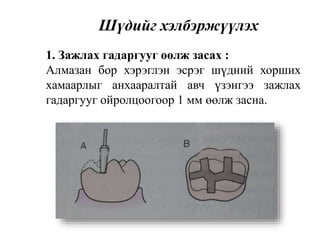 Шүдийг хэлбэржүүлэх
1. Зажлах гадаргууг өөлж засах :
Алмазан бор хэрэглэн эсрэг шүдний хорших
хамаарлыг анхааралтай авч үзэнгээ зажлах
гадаргууг ойролцоогоор 1 мм өөлж засна.
 