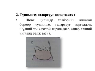 2. Түшилцэх гадаргууг өөлж засах :
• Шовх цилиндр хэлбэрийн алмазан
бороор түшилцэх гадаргууг зэргэлдээх
шүдний тэнхлэгтэй паралелаар хацар хэлний
чиглэлд өөлж засна.
 
