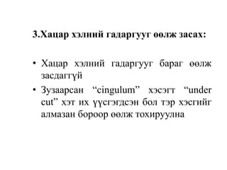 3.Хацар хэлний гадаргууг өөлж засах:
• Хацар хэлний гадаргууг бараг өөлж
засдаггүй
• Зузаарсан “сingulum” хэсэгт “under
cut” хэт их үүсгэгдсэн бол тэр хэсгийг
алмазан бороор өөлж тохируулна
 