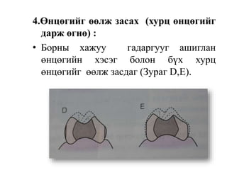 4.Өнцөгийг өөлж засах (хурц өнцөгийг
дарж өгнө) :
• Борны хажуу гадаргууг ашиглан
өнцөгийн хэсэг болон бүх хурц
өнцөгийг өөлж засдаг (Зураг D,E).
 