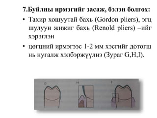 7.Буйлны ирмэгийг засаж, бэлэн болгох:
• Тахир хошуутай бахь (Gordon pliers), эгц
шулуун жижиг бахь (Renold pliers) –ийг
хэрэглэн
• цөгцний ирмэгээс 1-2 мм хэсгийг дотогш
нь нугалж хэлбэржүүлнэ (Зураг G,H,I).
 