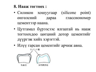8. Нааж тогтоох :
• Силикон хошуугаар (silicone point)
өнгөлсний дараа глассиономер
цементээр наана.
• Цутгамал бүрээсээс ялгаатай нь нааж
тогтоохдоо цөгцний дотор цементийг
дүүргэж хийх хэрэгтэй.
• Илүү гарсан цементийг арчиж авна.
 