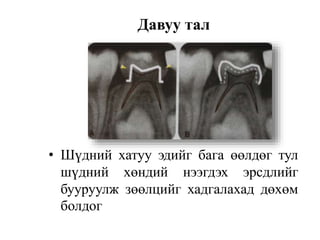 • Шүдний хатуу эдийг бага өөлдөг тул
шүдний хөндий нээгдэх эрсдлийг
бууруулж зөөлцийг хадгалахад дөхөм
болдог
Давуу тал
 