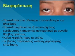 Βλεφαρόπτωση
• Προκαλείται από αδυναμία στον ανελκτήρα του
βλεφάρου
• Προκαλεί αμβλυωπία εξ αποστερήσεως
ερεθίσματος ή σημαντικό αστιγματισμό με συνοδό
θάμβος οράσεως
• Κλίση κεφαλής προς τα επάνω
• Σε βαριές περιπτώσεις: ανάγκη χειρουργικής
επέμβασης
 