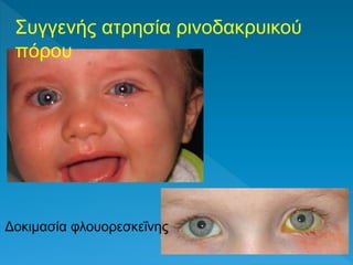 Συγγενής ατρησία ρινοδακρυικού
πόρου
Δοκιμασία φλουορεσκεΐνης
 