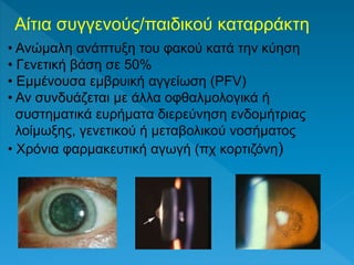 Αίτια συγγενούς/παιδικού καταρράκτη
• Ανώμαλη ανάπτυξη του φακού κατά την κύηση
• Γενετική βάση σε 50%
• Eμμένουσα εμβρυική αγγείωση (PFV)
• Αν συνδυάζεται με άλλα οφθαλμολογικά ή
συστηματικά ευρήματα διερεύνηση ενδομήτριας
λοίμωξης, γενετικού ή μεταβολικού νοσήματος
• Χρόνια φαρμακευτική αγωγή (πχ κορτιζόνη)
 