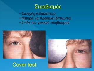 Στραβισμός
• Συνεχής ή διαλείπων
• Μπορεί να προκαλεί διπλωπία
• 2-4% του γενικού πληθυσμού
Cover test
 