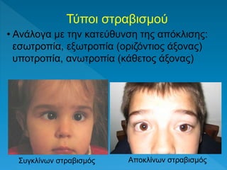 Τύποι στραβισμού
• Ανάλογα με την κατεύθυνση της απόκλισης:
εσωτροπία, εξωτροπία (οριζόντιος άξονας)
υποτροπία, ανωτροπία (κάθετος άξονας)
Συγκλίνων στραβισμός Αποκλίνων στραβισμός
 
