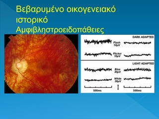 Βεβαρυμένο οικογενειακό
ιστορικό
Αμφιβληστροειδοπάθειες
 