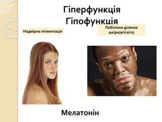 Гіперфункція
Гіпофункція
Надмірна пігментація
Побіління ділянок
шкіри(вітіліго)
Мелатонін
 