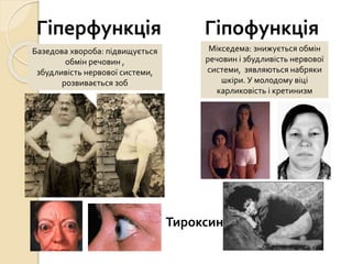Гіперфункція Гіпофункція
Базедова хвороба: підвищується
обмін речовин ,
збудливість нервової системи,
розвивається зоб
Мікседема: знижується обмін
речовин і збудливість нервової
системи, зявляються набряки
шкіри. У молодому віці
карликовість і кретинизм
Тироксин
 