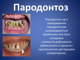 Пародонтоз
Пародонтоз–це є
захворювання
пародонти,яке
супроводжується
ураженням всіх його
складових
елементів,руйнування
зубоясневого з’єднання і
прогресуючою деструкцією
альвеолярних.
 