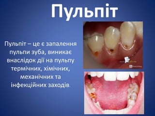 Пульпіт
Пульпіт – це є запалення
пульпи зуба, виникає
внаслідок дії на пульпу
термічних, хімічних,
механічних та
інфекційних заходів.
 