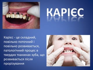 Карієс - це складний,
повільно поточний і
повільно розвивається,
патологічний процес в
твердих тканинах зуба, що
розвивається після
прорізування
 