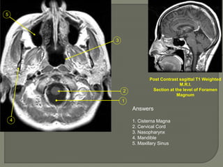 1
2
3
4
5
Post Contrast sagittal T1 Weighted
M.R.I.
Section at the level of Foramen
Magnum
Answers
1. Cisterna Magna
2. Cervical Cord
3. Nasopharynx
4. Mandible
5. Maxillary Sinus
 