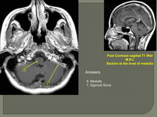 7
6
Post Contrast sagittal T1 Wtd
M.R.I.
Section at the level of medulla
Answers
6. Medulla
7. Sigmoid Sinus
 