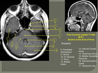 1
5
8
9
1
0
1
1
1
2
1
3
1
4
1
6
1
7
Post Contrast sagittal T1 Wtd
M.R.I.
Section at the level of Pons
Answers
8. Cerebellar
Hemisphere
9. Vermis
10. IV Ventricle
11. Pons
12. Basilar
Artery
13. Internal Carotid
Artery
14. Cavernous Sinus
15. Middle Cerebellar
Peduncle
16. Internal Auditory
Canal
17. Temporal Lobe
 