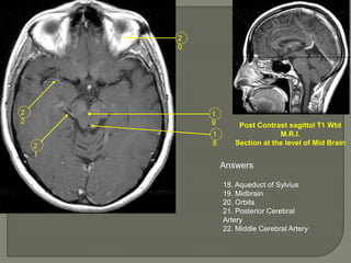 1
8
1
9
2
0
2
1
2
2
Post Contrast sagittal T1 Wtd
M.R.I.
Section at the level of Mid Brain
Answers
18. Aqueduct of Sylvius
19. Midbrain
20. Orbits
21. Posterior Cerebral
Artery
22. Middle Cerebral Artery
 