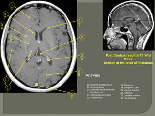 2
8
2
9
3
0
3
1
3
2
3
8
3
3
3
4
3
6
3
5
3
7
Post Contrast sagittal T1 Wtd
M.R.I.
Section at the level of Thalamus
Answers
28. Superior Sagittal Sinus
29. Occipital Lobe
30. Choroid Plexus within the
occipital horn
31. Internal Cerebral Vein
32. Frontal Horn
33. Thalamus
34. Temporal Lobe
35. Internal Capsule
36. Putamen
37. Caudate Nucleus
38. Frontal Lobe
 