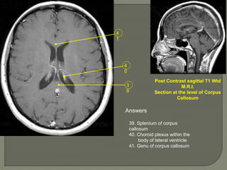 3
9
4
0
4
1
Post Contrast sagittal T1 Wtd
M.R.I.
Section at the level of Corpus
Callosum
Answers
39. Splenium of corpus
callosum
40. Choroid plexus within the
body of lateral ventricle
41. Genu of corpus callosum
 