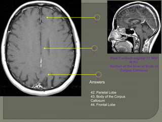4
2
4
3
4
4
Post Contrast sagittal T1 Wtd
M.R.I.
Section at the level of Body of
Corpus Callosum
Answers
42. Parietal Lobe
43. Body of the Corpus
Callosum
44. Frontal Lobe
 