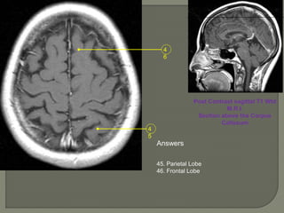 4
5
4
6
Post Contrast sagittal T1 Wtd
M.R.I.
Section above the Corpus
Callosum
Answers
45. Parietal Lobe
46. Frontal Lobe
 