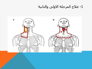 1-‫والثانية‬ ‫االولى‬ ‫المرحلة‬ ‫عالجĬ
 
