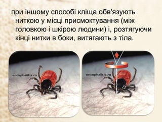 при іншому способі кліща обв'язують
ниткою у місці присмоктування (між
головкою і шкірою людини) і, розтягуючи
кінці нитки в боки, витягають з тіла.
 