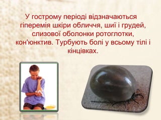 У гострому періоді відзначаються
гіперемія шкіри обличчя, шиї і грудей,
слизової оболонки ротоглотки,
кон'юнктив. Турбують болі у всьому тілі і
кінцівках.
 