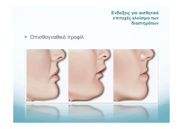 κλείσιμο προφίλκαι έξω και Κρύσταλ χ