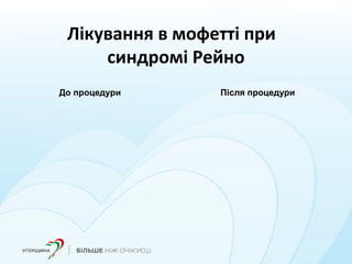 Лікування в мофетті при
синдромі Рейно
До процедури Після процедури
 