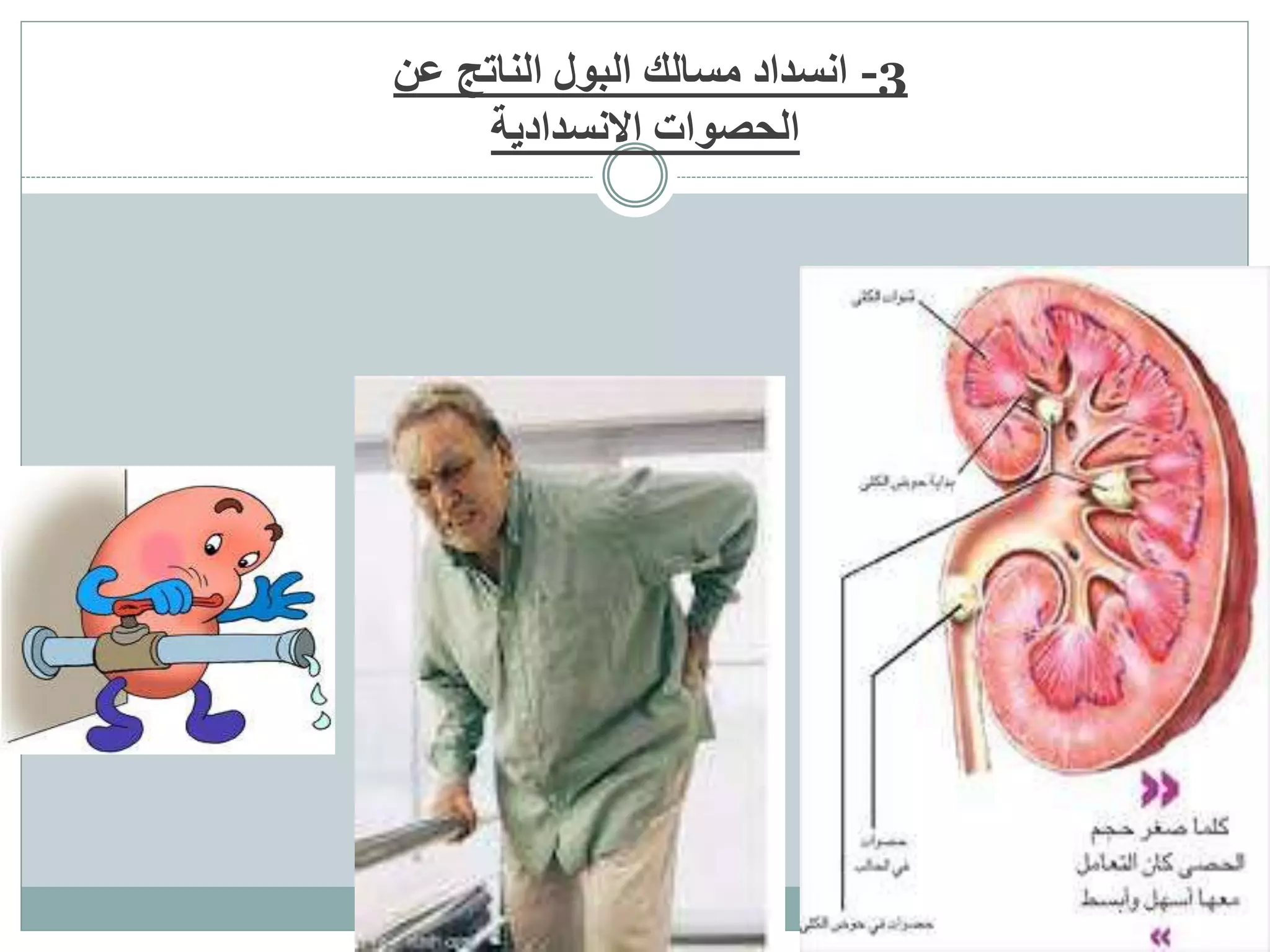 ‫عن‬ ‫الناتج‬ ‫البول‬ ‫مسالك‬ ‫انسداد‬ -3
‫الحصوات‬‫االنسدادية‬
 