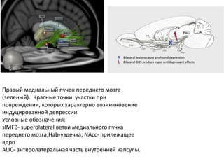 Правый медиальный пучок переднего мозга
(зеленый). Красные точки участки при
повреждении, которых характерно возникновение
индуцированной депрессии.
Условные обозначения:
slMFB- superolateral ветви медиального пучка
переднего мозга;Hab-уздечка; NАcc- прилежащее
ядро
ALIC- антеролатеральная часть внутренней капсулы.
 