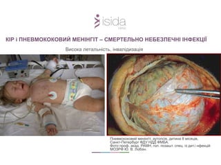 КІР і ПНЕВМОКОКОВИЙ МЕНІНГІТ – СМЕРТЕЛЬНО НЕБЕЗПЕЧНІ ІНФЕКЦІЇ
Висока летальність, інвалідизація
Пневмококовий менінгіт, аутопсія, дитина 8 місяців,
Санкт-Петербург ФДУ НДД ФМБА.
Фото проф. акад. РАМН, гол. позашт. спец. із дит.і нфекцій
МОЗРФ Ю. В. Лобзін.
 