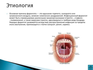  Основная причина фарингита — это вдыхание горячего, холодного или
загрязненного воздуха, влияние химических раздражений. Инфекционный фарингит
может быть спровоцирован различными микроорганизмами (стрепто-, стафило-
, пневмококки), а также вирусами (гриппа, аденовирусы) и грибами рода Кандида.
Нередко фарингит развивается вследствие распространения инфекции за пределы
очага воспаления, прилежащего к глотке (синусит, ринит, кариес).
 