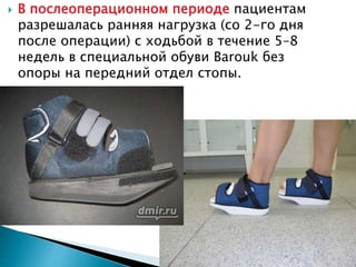  В послеоперационном периоде пациентам
разрешалась ранняя нагрузка (со 2-го дня
после операции) с ходьбой в течение 5–8
недель в специальной обуви Barouk без
опоры на передний отдел стопы.
 
