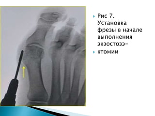  Рис 7.
Установка
фрезы в начале
выполнения
экзостозэ-
 ктомии
 