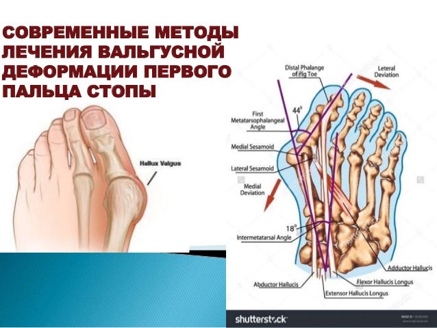 СОВРЕМЕННЫЕ МЕТОДЫ ЛЕЧЕНИЯ ВАЛЬГУСНОЙ ДЕФОРМАЦИИ ПЕРВОГО ПАЛЬЦА СТОПЫ