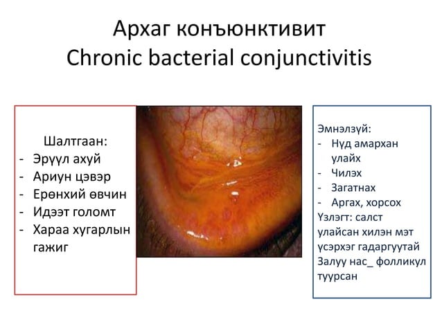 салстын үрэвсэлт өвчин