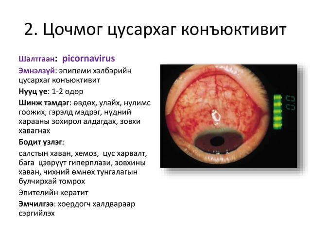 салстын үрэвсэлт өвчин