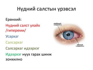салстын үрэвсэлт өвчин | PPT