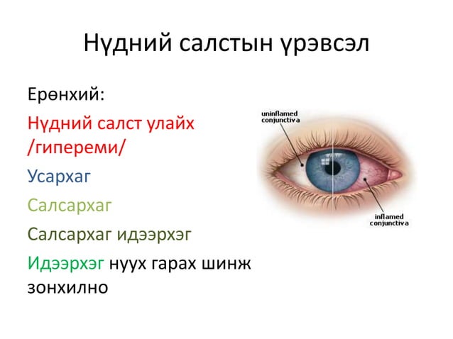 салстын үрэвсэлт өвчин