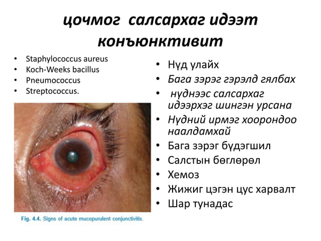 салстын үрэвсэлт өвчин