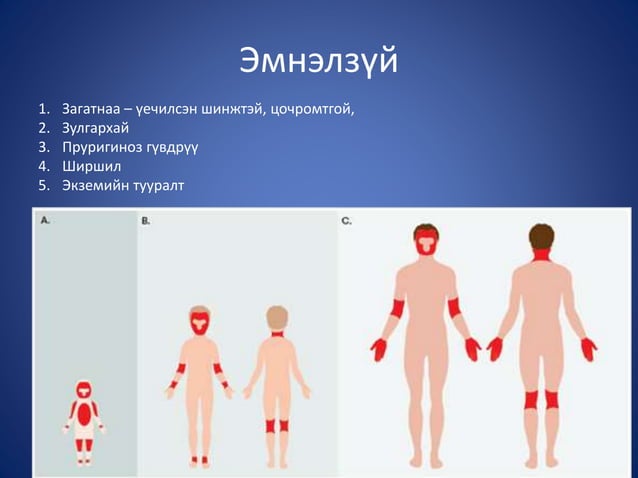 атопийн дерматит